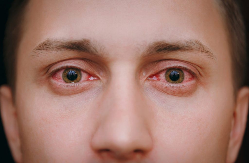 Eye pain in the form of allergies causing red and itchy eye